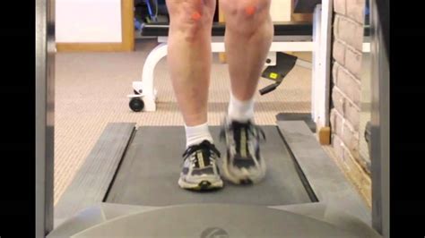 internal tibial torsion in adults